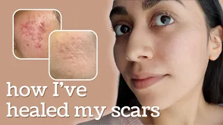 Healing Hyperpigmentation + Deep Pitted Acne Scars (this is what I’ve done)