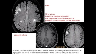 69. I-CAA and ABRA; CAA related inflammation, amyloid beta related angiitis, encephalopathy, elderly