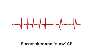 Pacemakers and 'slow' AF patients