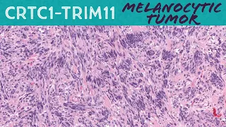 CRTC1::TRIM11 Fusion Melanocytoma/Melanocytic Tumor (vs clear cell sarcoma)(AIP France 2021 Case 10)