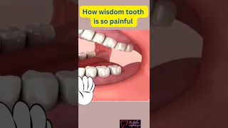 This is Why yourwisdom Tooth hurts🦷⚠️ #wisdomtooth#pain #dentistry #shorts #youtubeshorts #viral