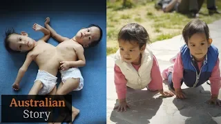 The journey of conjoined twins Nima and Dawa | Australian Story