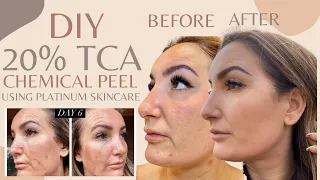 DIY 20% TCA PEEL AT HOME/USING PLATINUM SKINCARE PRODUCTS