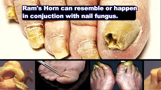 Rams Horn Nails - World's Longest Nails?