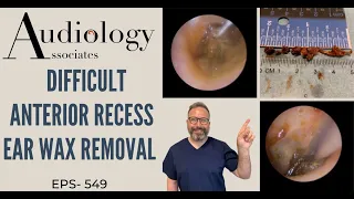 DIFFICULT ANTERIOR RECESS EAR WAX REMOVAL - EP549