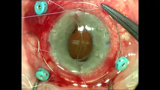 Landers Temporary Keratoprosthesis, Retinal Detachment Repair and Penetrating Keratoplasty