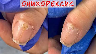 Onychorrhexis Causes and Treatment / Cracked Nail