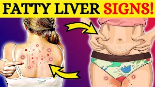 SILENT KILLER! 8 HIDDEN Signs That Your Liver Is DYING! Don’t Ignore