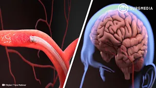 Percutaneous Clot Removal in Acute Ischemic Stroke