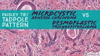 Microcystic Adnexal Carcinoma vs Desmoplastic Trichoepithelioma (Paisley Tie/Tadpole Pattern)