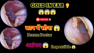 Gold Orb Stuck To Eardrum | Dream Doctor V