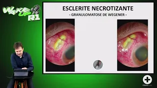 Wake UP R1 #15 - ESCLERITE NECROTIZANTE (Granulomatose de Wegener)