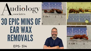 30 MINS OF EAR WAX REMOVALS - EP514