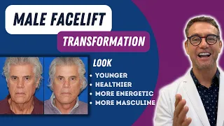 MALE DEEP-PLANE FACELIFT TRANSFORMATION