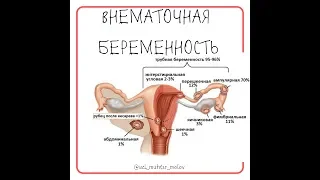 Внематочная беременность на УЗИ + эластография (13-8-19)