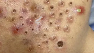 Loan Nguyen Acne spa