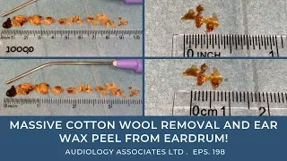 MASSIVE COTTON WOOL REMOVAL AND EAR WAX PEEL FROM EARDRUM - EP 198