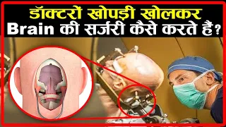 डॉक्टरों खोपड़ी खोलकर Brain की सर्जरी कैसे करते हैं ? | Human Brain Surgery