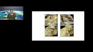 GE Webinar :Left Atrial Appendage Tips and Tricks by Dr Ranjan Shetty