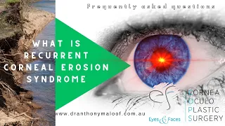 FAQ - What is recurrent corneal erosion syndrome with Dr Anthony Maloof, Sydney