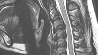 Chiari 1 Malformation of hindbrain - Brain MRI scan | First Look MRI