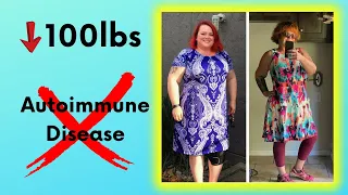 Autoimmune Disease & 100lbs Weight Loss - Carnivore Diet