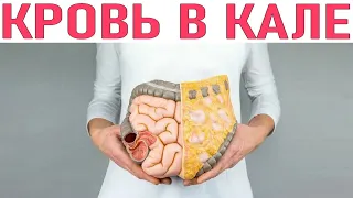 КРОВЬ В КАЛЕ | Почему кал бывает с кровью и что с этим делать