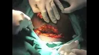 Caesarean Section: Step 2 - Abdominal Incision