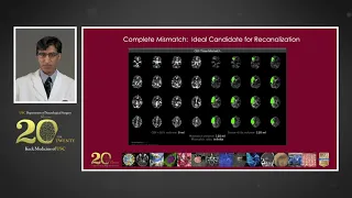 Neurosurgical Management of Acute Ischemic Stroke