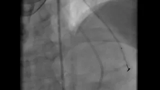 Coronary artery perforation