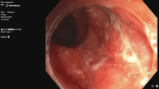 Язвенный колит, тотальное поражение, умеренная степень эндоскопической активности.