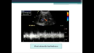 Renal Arteries From Start to Finish