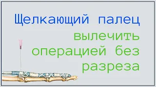 Как вылечить щелкающий палец без разреза? Результат сразу на столе. В этом видео.