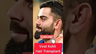 virat kohli Hair transplant || celebrity hair transplant #shorts  #indiancricketteam  #httamilan