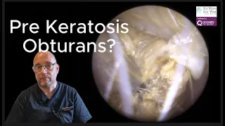 Pre Keratosis Obturans? - Episode 87 #ear #earwax #earwaxremoval