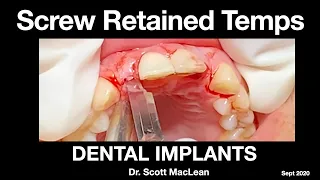 *NEW - Pre Surgical Screw Retained Temps and Implant Surgery - Explicit Surgery