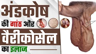 Varicocele or Epididymal Cyst Causes , Symptoms & Treatment | अंडकोष की गांठ और वैरीकोसेल का इलाज