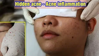 Cách điều trị mụn ẩn - mụn viêm hiệu quả. Tại Hiền Vân Spa - bài 261