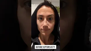 Before and After Septoplasty and Turbinate Reduction | 2 Weeks Later