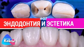 Эндодонтия и эстетика. #07