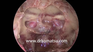 #A6 Posterior wall of the Sphenoid Sinus; Anatomy for Endoscopic Endonasal Skull Base Surgery