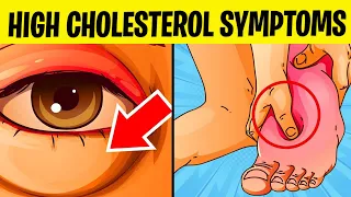 9 High Cholesterol Symptoms You Should Never Ignore
