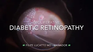 Proliferative diabetic retinopathy - Author: Filipe Lucatto MD