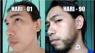 [ progress ] Brewok Minoxidil Hari Ke 90 || Minoxidil Beard 3 Months, Time Lapse