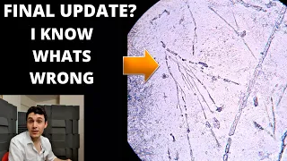 FINAL UPDATE? - Rapid Skin Shedding Case (KOH Test Under The Microscope)