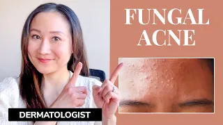Dermatologist's Guide to FUNGAL ACNE | What is it? & Treatments