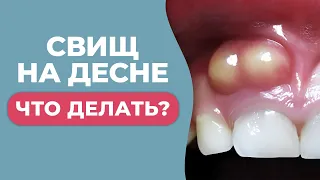 ЧЕМ ОПАСНА ШИШКА НА ДЕСНЕ И КАК БЫСТРО ОТ НЕЕ ИЗБАВИТЬСЯ?