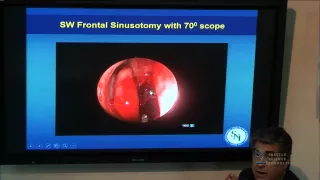 Surgically Mastering the Frontal & Sphenoid Sinuses Part 2 by Donald Lanza, M.D., M.S.