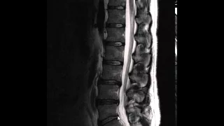 Spinal Arthritis X-Ray (This Is What It Looks Like)