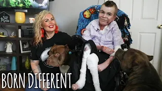 The Incredible Teen With Butterfly Skin | BORN DIFFERENT